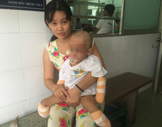 Hoại tử, thối thịt, tội nghiệp bé 2 tuổi phải cắt tứ chi
