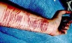 Nữ sinh tự ngược đãi bản thân, lấy dao rạch 16 nhát vào tay thấy 'lòng nhẹ nhõm'