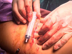 Cứu sống thanh niên bị đâm thấu thành bụng nguy kịch, chảy máu dữ dội