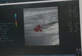 Thương tâm bé 5 tuổi mất cánh tay do bị cuốn vào băng chuyền