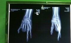 Lấy 2 ngón chân ghép thành ngón tay cho cô gái trẻ