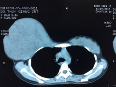 Xúc động người mẹ trì hoãn phẫu thuật khối u tuyến vú 'khủng' để sinh con