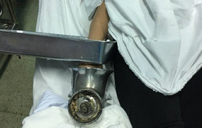 Cấp cứu bệnh nhân bàn tay dập nát vì bị cuốn vào máy xay thịt