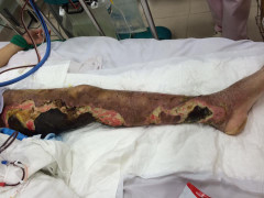 Chân hoại tử bốc mùi hôi thối vì tin 'bác sĩ google' hơn bác sĩ thật