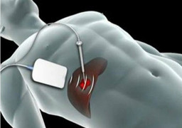 Lần đầu cắt u gan không cần mở ổ bụng