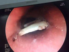 Hóc xương thủ lợn, nam thanh niên bị rách thực quản suýt chết