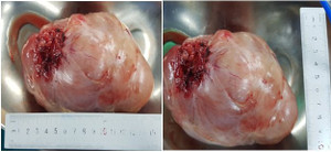 Phẫu thuật thành công bệnh nhân nữ 74 tuổi bị u lớn chèn ép tim phổi