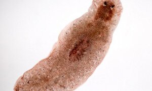 Rùng mình cảnh ký sinh trùng bơi trong mắt khiến một thanh niên bị mù