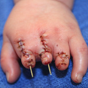 Nhói lòng trước hàng loạt em bé mắc bệnh như Bôm, con trai diễn viên Quốc Tuấn