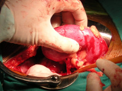 Hai ca ghép thận không cùng huyết thống thành công tại Bệnh viện Xanh Pôn