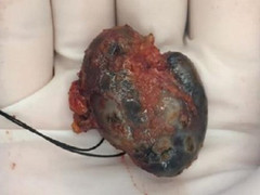 Nhiễm mực từ hình xăm, nữ bệnh nhân mắc khối u kỳ lạ