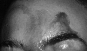 Cô gái duy nhất trên thế giới đổ mồ hôi có máu vì mắc bệnh hiếm