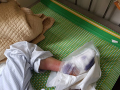 Nỗi ám ảnh của bệnh nhân tiểu đường khi phải cắt chân