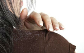 Không phải do ở bẩn - 5 điều này cũng khiến đầu của bạn phủ đầy gàu