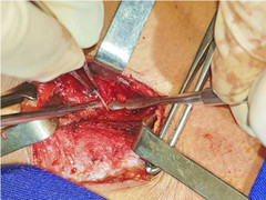 Xương cá sắc nhọn đâm xuyên thực quản vào vùng cổ bệnh nhân