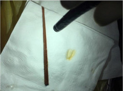 Nhập viện vì ăn 6 cây nhang đang cháy làm mồi nhậu