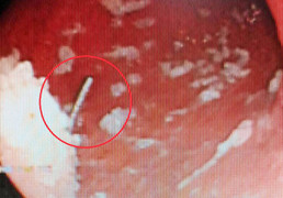 Gắp cây kim dài 2,5 cm trong bụng nam công nhân