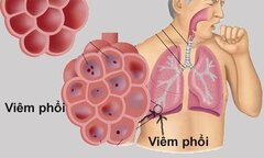 Căn bệnh gây chết người hàng đầu ở trẻ, cha mẹ cần nhớ các dấu hiệu điển hình này