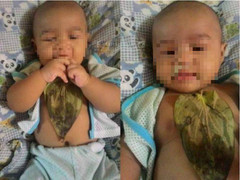 Bé gái bỏng ngực nặng vì trị sổ mũi bằng lá trầu