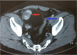 Bác sĩ chạy đua với 'tử thần' cứu bệnh nhân chảy máu ồ ạt