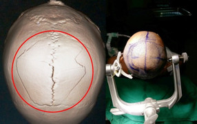 Nữ giáo sư hàng đầu thế giới đến Việt Nam mổ phình mạch não