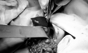 Bé sơ sinh có ruột, dạ dày 'nhầm chỗ' chui lên lồng ngực