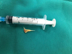 Xương cá nằm trong khí quản bệnh nhân suốt 2 tuần