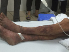 Giết lợn phục vụ đám cưới, ông lão nhiễm căn bệnh chết người