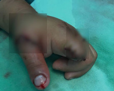 Bé trai 3 tuổi đứt lìa hai ngón tay vì xích xe máy