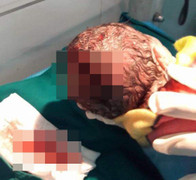 Thai nhi bị rách đầu vì mẹ chồng dùng dao giúp con dâu tự đẻ tại nhà