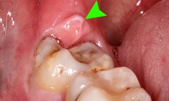Răng số 8 là răng gì?