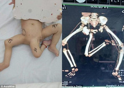 Kỳ lạ: Cậu bé sinh ra có 3 chân khác người