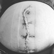 Xem những hình ảnh sinh mổ để thấy các bà mẹ đã trải qua đau đớn như thế nào