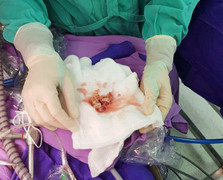 Đau bụng kèm sốt, bé gái 3 tuổi mắc bệnh hiếm gặp