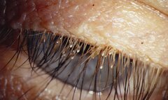 Chuyện khó tin: Đôi mắt rất dễ bị lây các bệnh qua đường tình dục