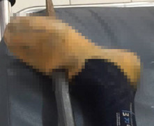 Người đàn ông bị xà beng đâm xuyên thấu bàn chân