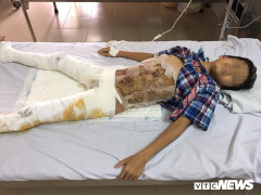 Xót xa cảnh bố mẹ cắn răng nhịn ăn, dành tiền mổ cho con trai bỏng nặng