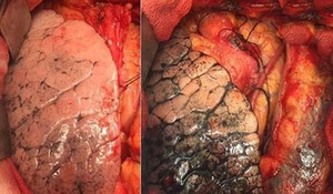 Dấu hiệu nhận biết ung thư phổi giai đoạn cuối