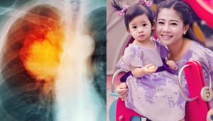 Ung thư phổi là gì, ung thư phổi có chữa được không?