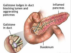 Uống rượu 3 ngày liên tục, cán bộ hải quan mất mạng vì viêm tụy cấp