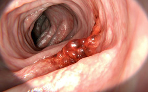 5 thói quen ăn uống người Việt nào cũng mắc dễ gây ung thư dạ dày