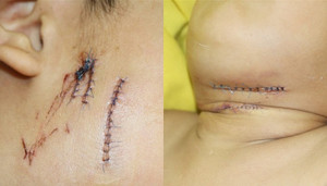 Cháu bé 4 tuổi bị chó nhà cắn trọng thương ở cổ