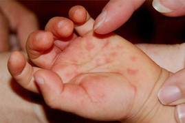 Dịch chồng dịch ở TP.HCM: Chuyên gia lý giải loạt thắc mắc về bệnh tay chân miệng