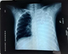 Bé gái ở Đồng Nai mắc bệnh cực hiếm, cả thế giới chưa đến 20 ca