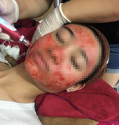 Sự thật về các phương pháp 'cấy' tinh chất, lăn kim trẻ hóa da