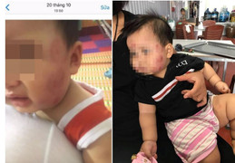 Bé 11 tháng tuổi bị cắn khắp mặt: Nhóm trẻ mầm non hoạt động chui