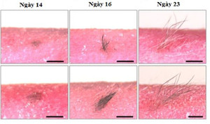Lớp da nhân tạo cấy ghép cho người bị bỏng hoặc rụng tóc