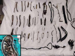 Bác sĩ lấy búi kim loại nặng 1,5kg trong dạ dày người phụ nữ