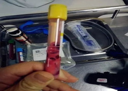 Bác sĩ 'hoảng sợ' khi máu bệnh nhân có màu hồng kỳ quái
