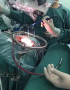 Rùng mình cảnh bác sĩ lôi ký sinh trùng dài 15 cm từ trong não cậu bé